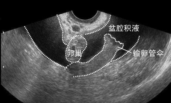 盆腔积液真的是红颜祸水?